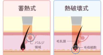 蓄熱式・熱破壊式レーザー